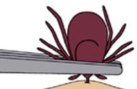 Illustration of tick being pulled from the skin with tweezers.